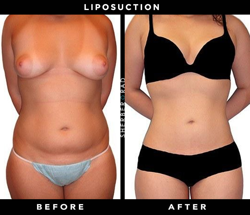 Liposuction Before and After