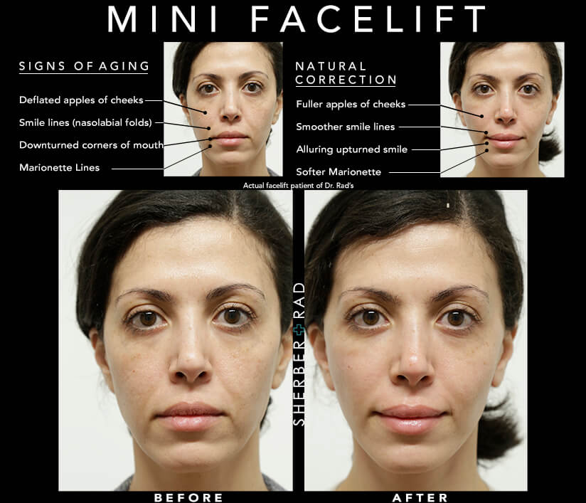 Mini-Face Lift Infographic