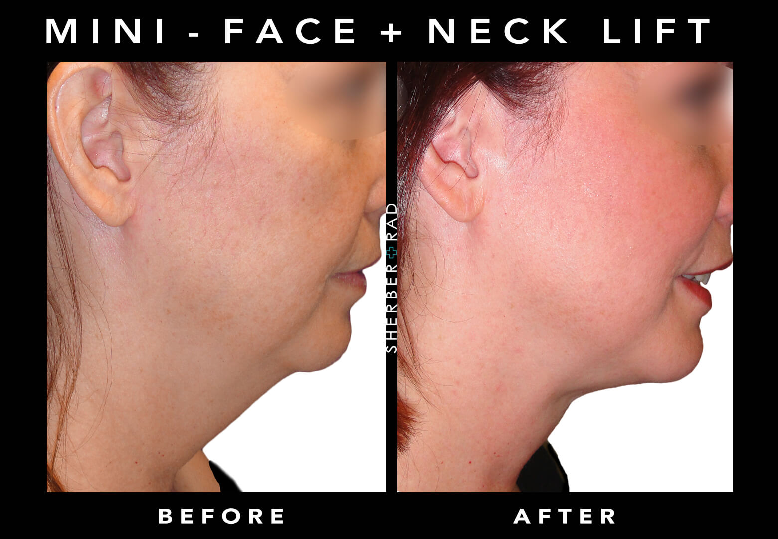 Mini-Face Lift Patient Before & After Procedure