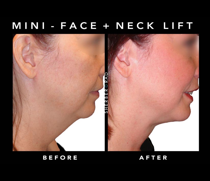 Mini Face Lift Surgery Results Washington DC