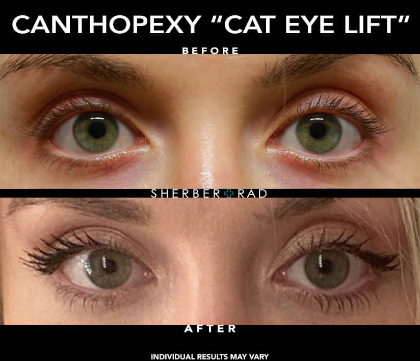 Actual Cat Eye Reshaping Patient