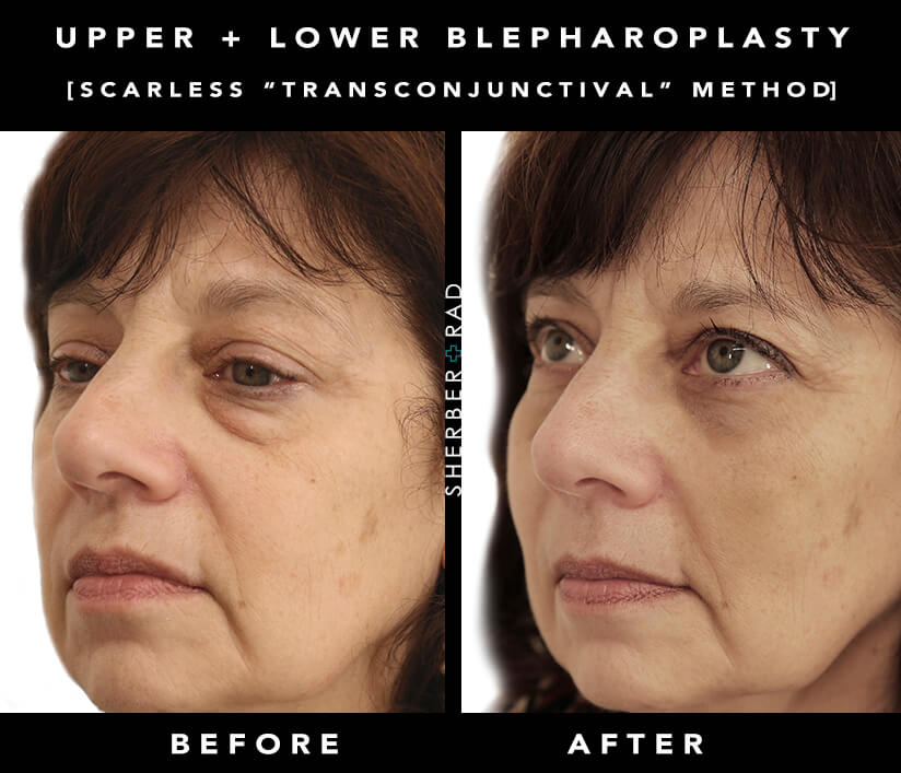 Actual Patient of Dr. Ariel Rad who had both an Upper and Lower Blepharoplasty in Washington D.C.