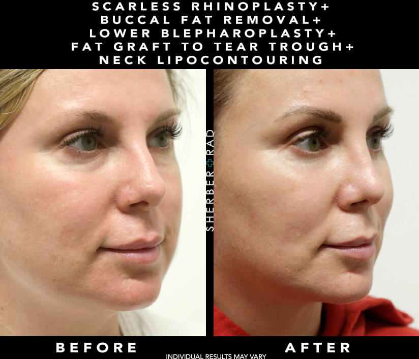 Buccal Fat Removal Before and After