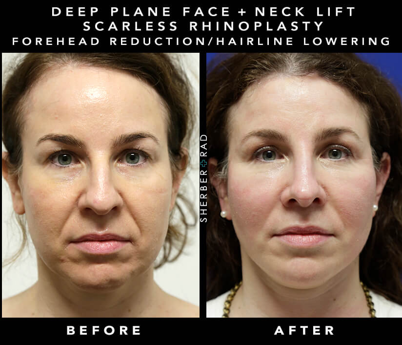 Actual Facial Cosmetic Surgery Patient