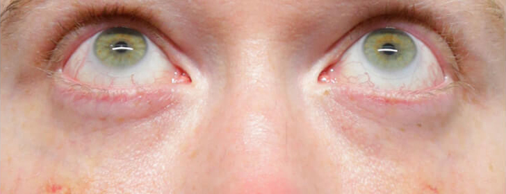 Female Eyelid Lift