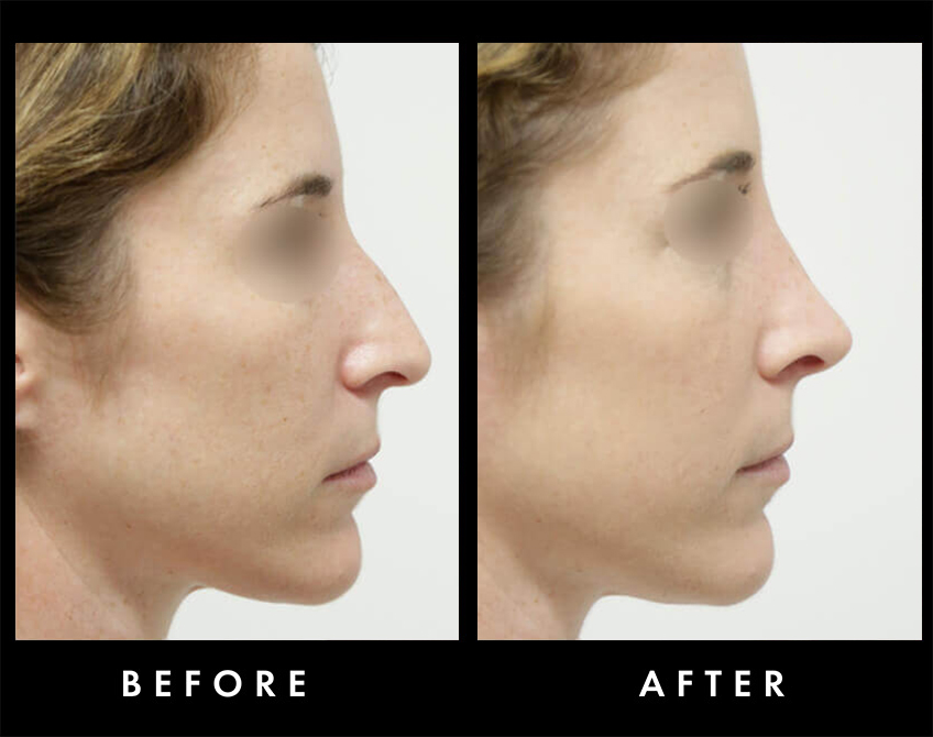 Nasal Hump Reduction Before & After Washington DC