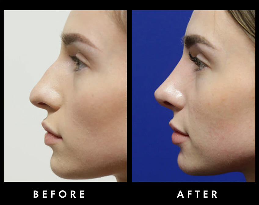 Nasal Hump Reduction Before & After Washington DC