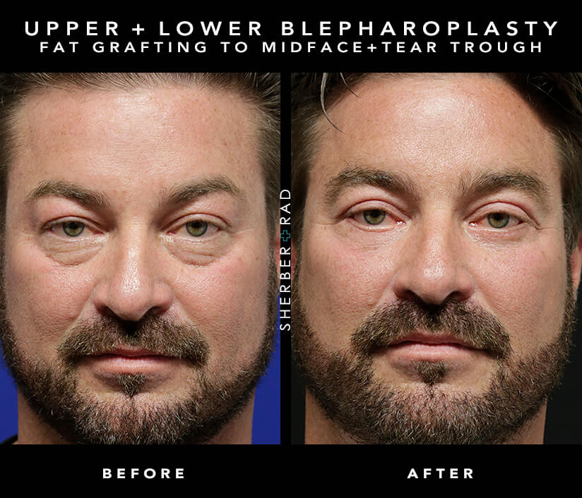 Actual Patient of Dr. Ariel Rad who had a upper and lower blepharoplasty