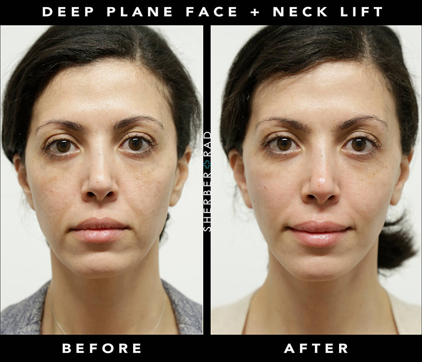 Facelift in Your Forties | Before & After