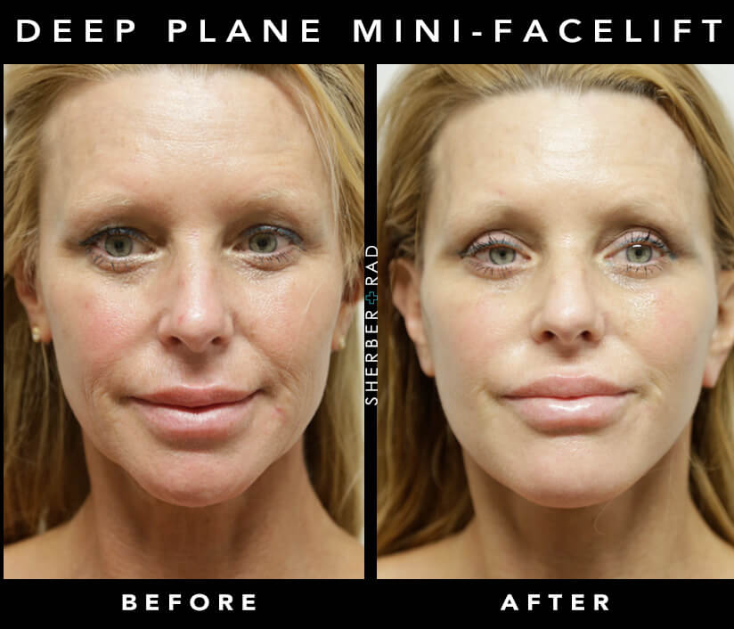 Facelift in Your Forties | Before & After