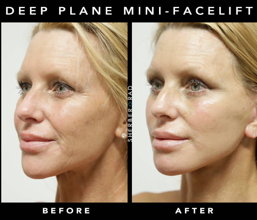 Facelift Before & After Results