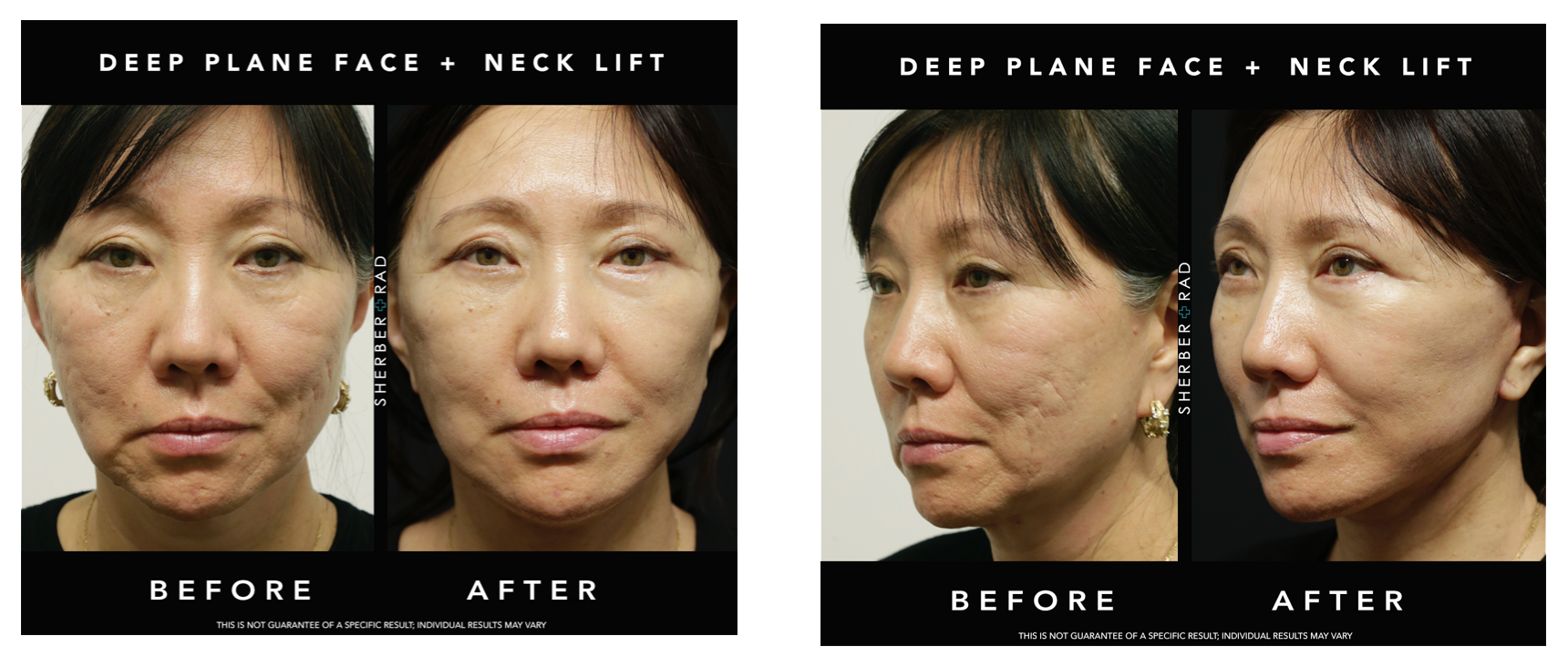 Revision Facelift Before & After Washington DC