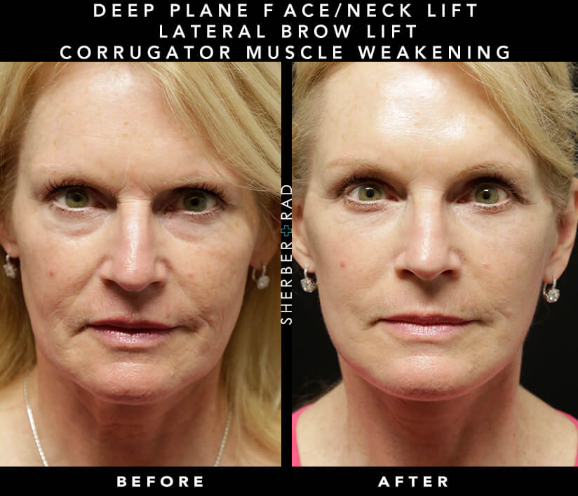 Surgical Frown Line Reduction Before & After Results
