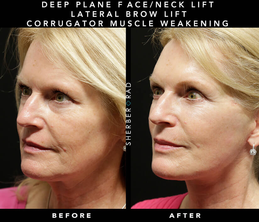 Surgical Frown Line Reduction Before & After Results