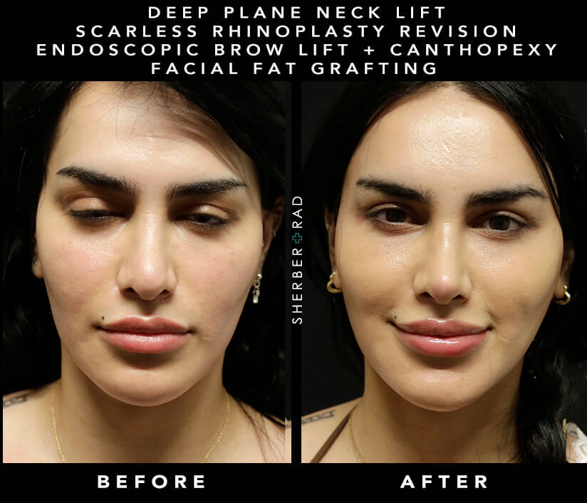 Actual Facial Cosmetic Surgery Patient