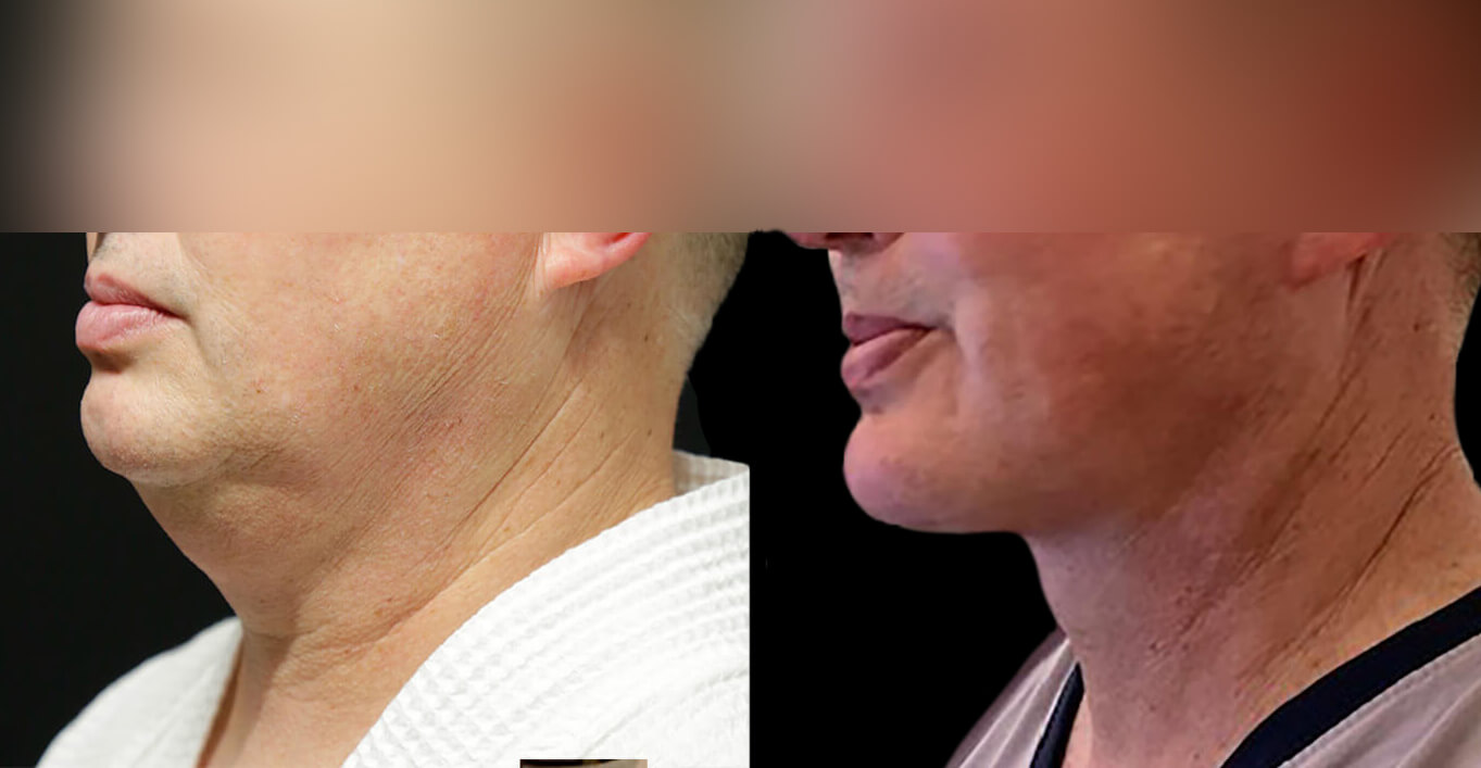 Male Facelift Before & After Results