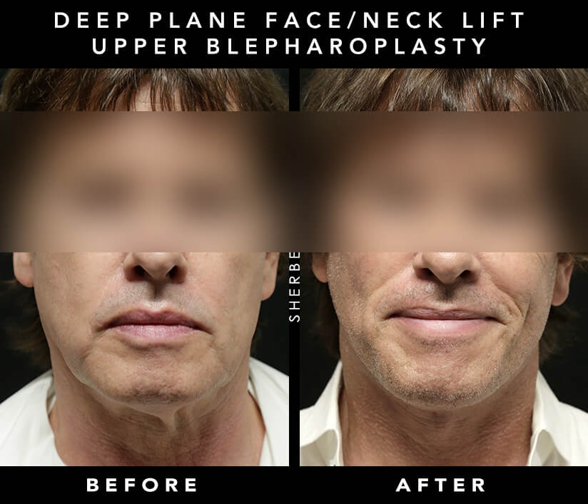 Male Neck Lift  Before & After Results