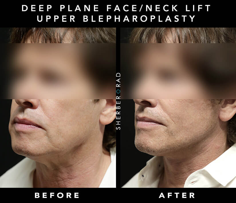Actual Facial Cosmetic Surgery Patient Before and After Washington DC