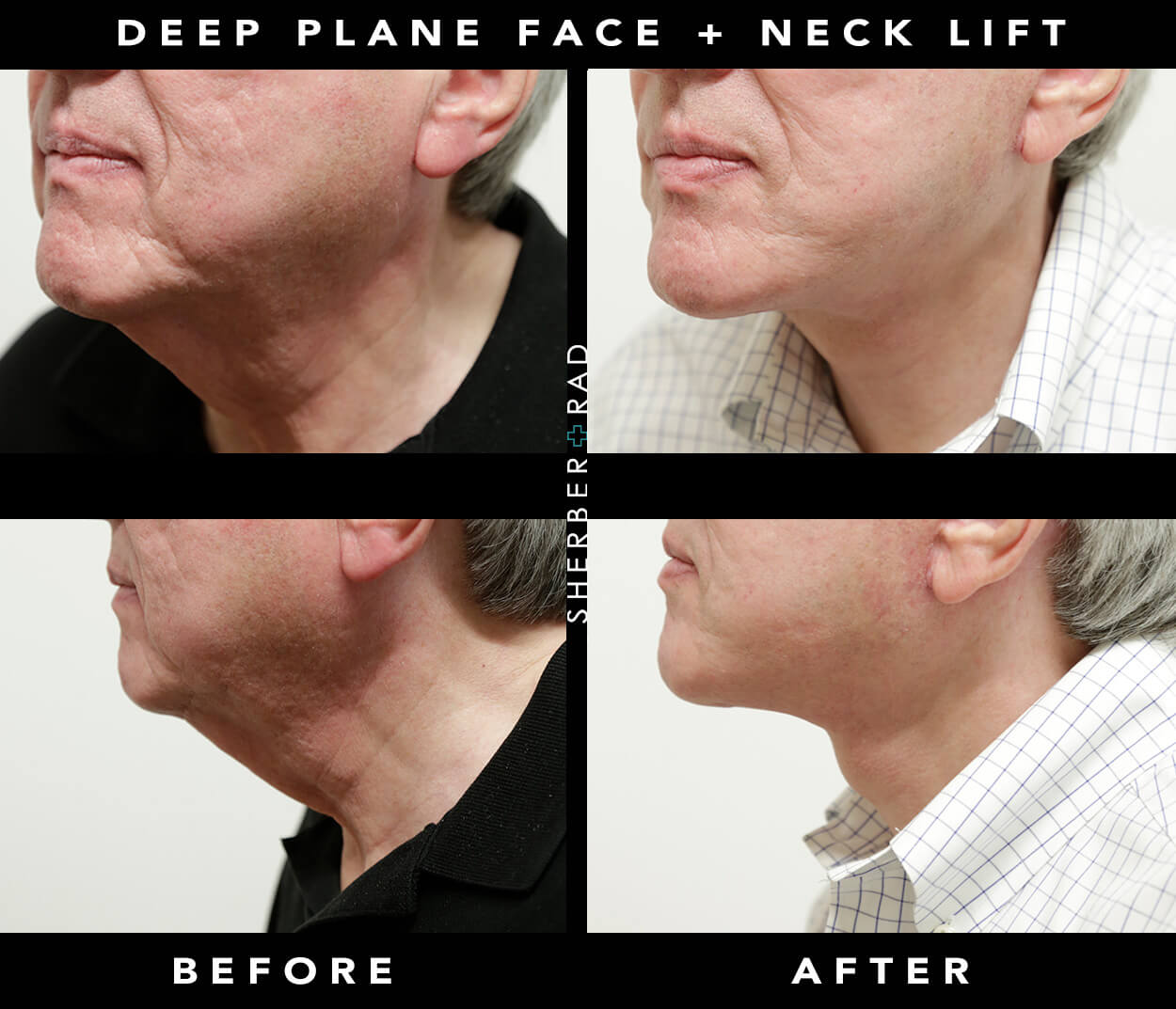 Facelift Before & After Results Washington DC