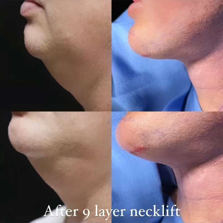 Facelift Before & After Results
