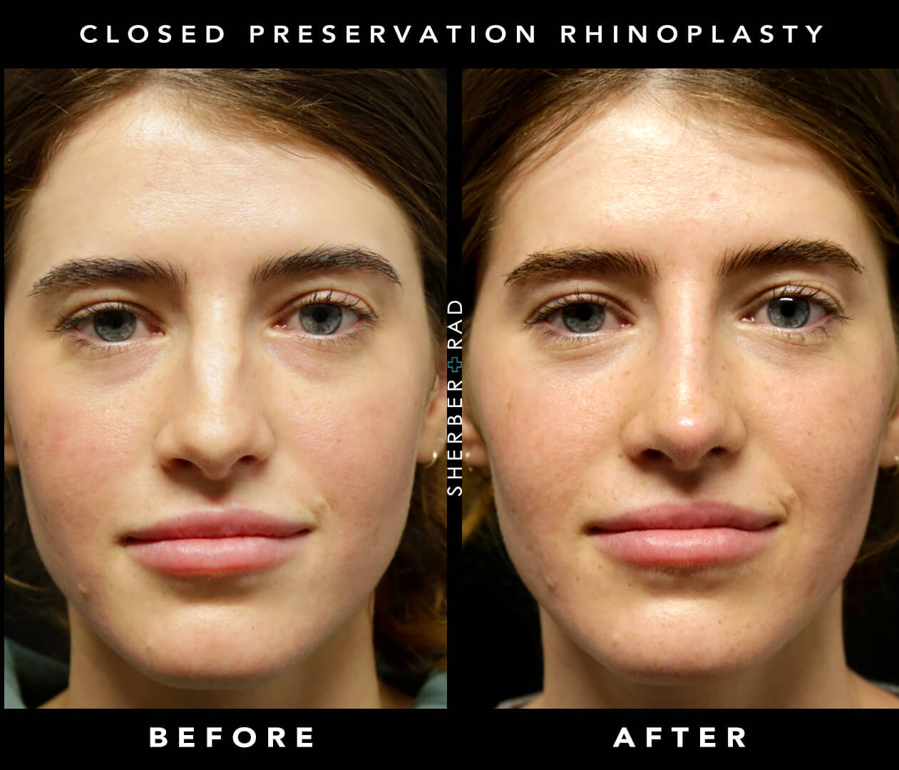Preservation Rhinoplasty Before & After Washington DC
