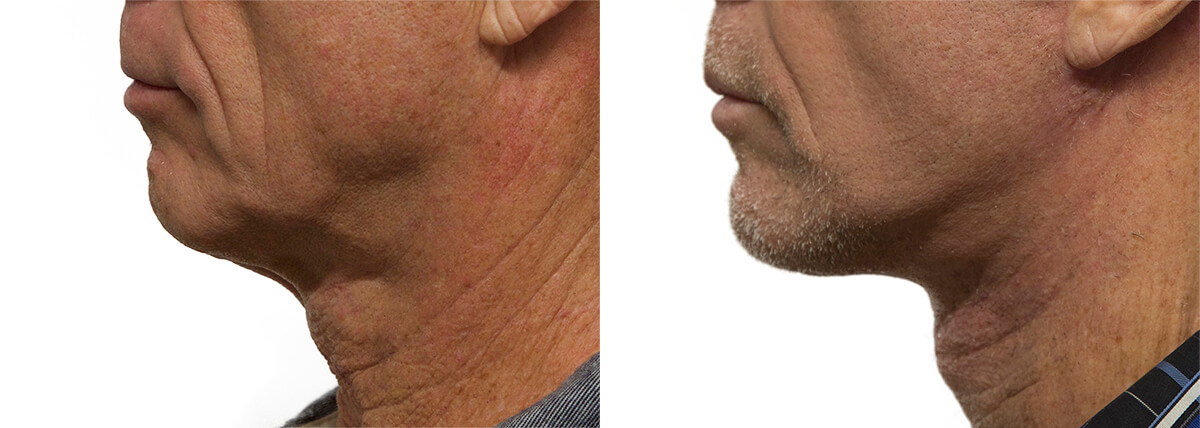 Male Neck Lift  Before & After Results