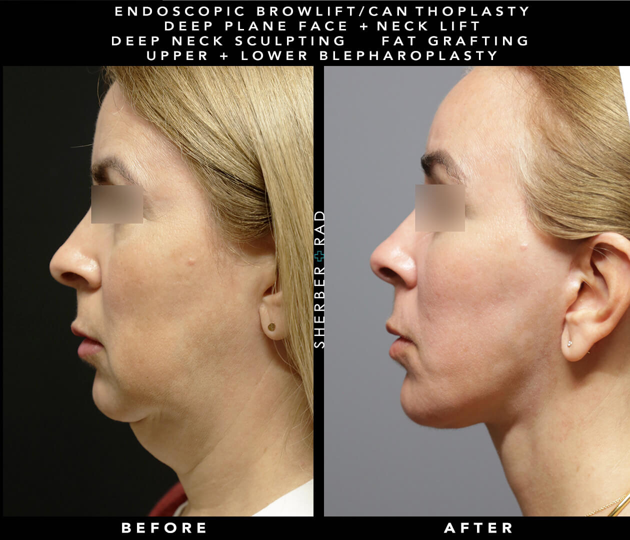 Deep Neck Sculpting Before and After Results