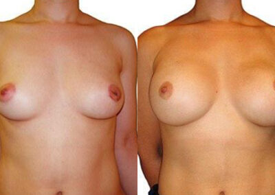 Implants before and after photos by Sherber and Rad in Washington, DC