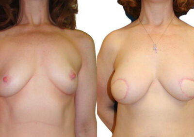 Nipple Reconstruction before and after photos by Sherber and Rad in Washington, DC