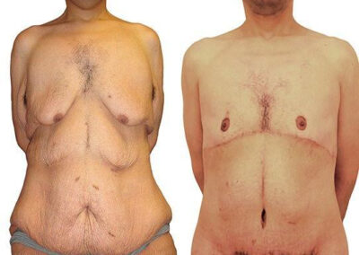 Massive Weight Loss before and after photos by Sherber and Rad in Washington, DC