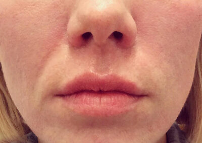 Cheek Lift + Augmentation before and after photos by Sherber and Rad in Washington, DC