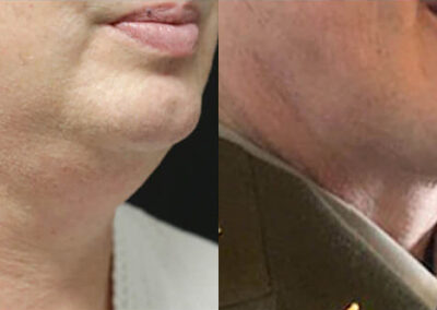Neck Lift before and after photos by Sherber and Rad in Washington, DC
