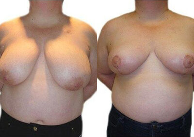 Breast Lift + Reduction before and after photos by Sherber and Rad in Washington, DC