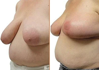 Lumpectomy Reconstruction before and after photos by Sherber and Rad in Washington, DC