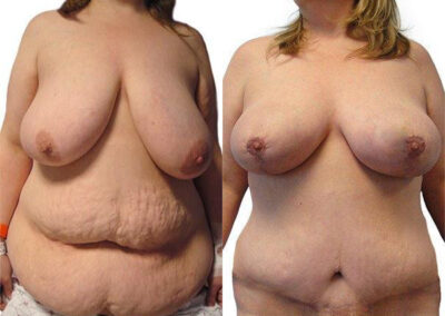 Breast Lift + Reduction before and after photos by Sherber and Rad in Washington, DC
