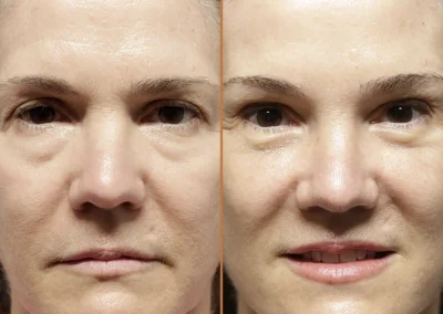 Brow Forehead Lift before and after photos by Sherber and Rad in Washington, DC