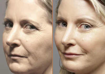 Brow Forehead Lift before and after photos by Sherber and Rad in Washington, DC