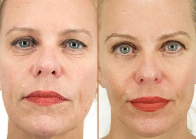 Brow Forehead Lift before and after photos by Sherber and Rad in Washington, DC