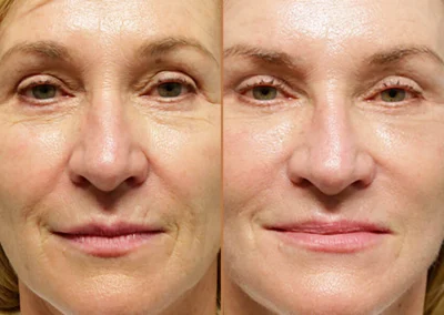Brow Forehead Lift before and after photos by Sherber and Rad in Washington, DC