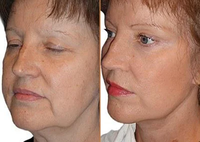 Brow Forehead Lift before and after photos by Sherber and Rad in Washington, DC