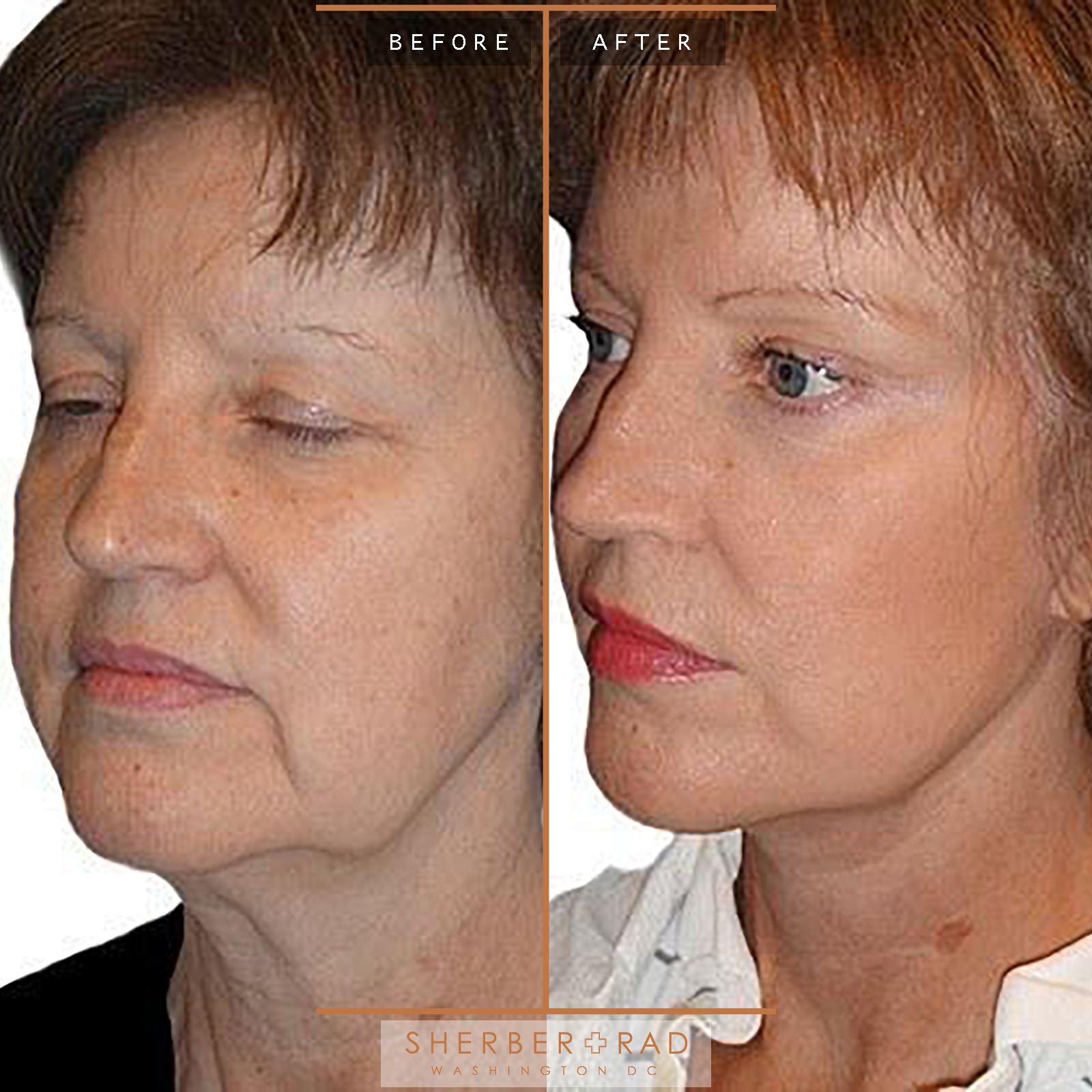 Brow Forehead Lift before and after photos by Sherber and Rad in Washington, DC