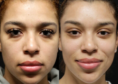 Brow + Forehead Lift before and after photos by Sherber and Rad in Washington, DC
