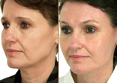 Brow Forehead Lift before and after photos by Sherber and Rad in Washington, DC