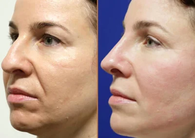 Brow Forehead Lift before and after photos by Sherber and Rad in Washington, DC