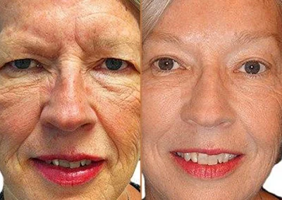 Brow Forehead Lift before and after photos by Sherber and Rad in Washington, DC