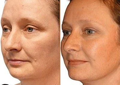 Brow Forehead Lift before and after photos by Sherber and Rad in Washington, DC