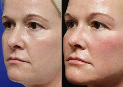 Brow Forehead Lift before and after photos by Sherber and Rad in Washington, DC