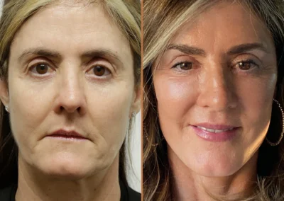 Brow Forehead Lift before and after photos by Sherber and Rad in Washington, DC