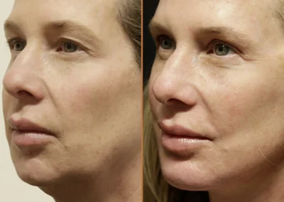 Brow Forehead Lift before and after photos by Sherber and Rad in Washington, DC
