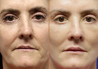 Brow Forehead Lift before and after photos by Sherber and Rad in Washington, DC